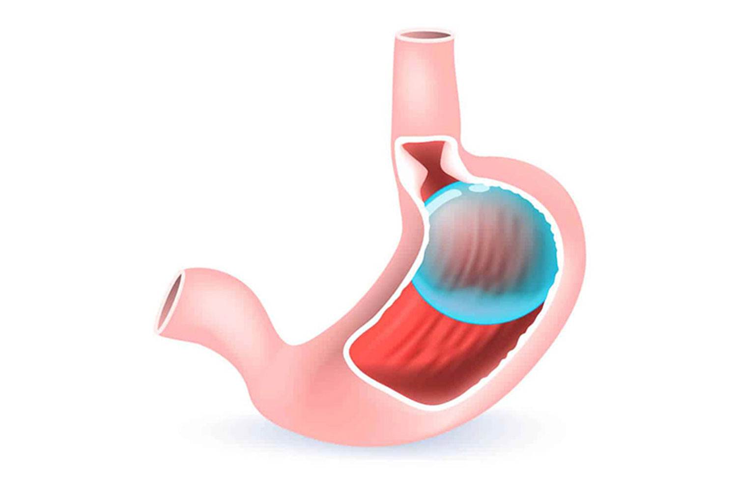 Gastric Balloon