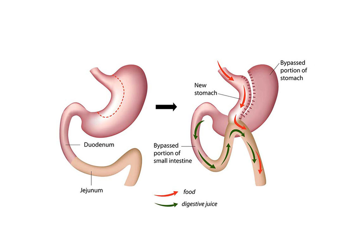 Gastric Bypass 