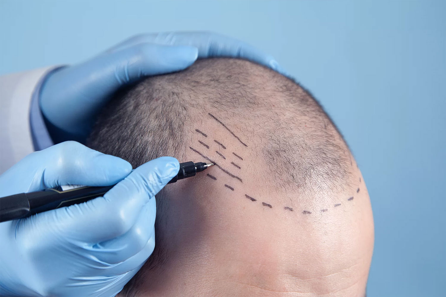 Hair Transplant