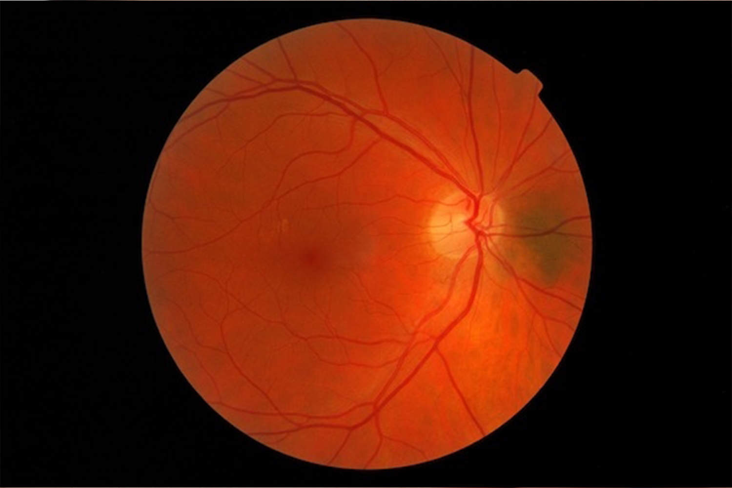 Retinal diseases: 