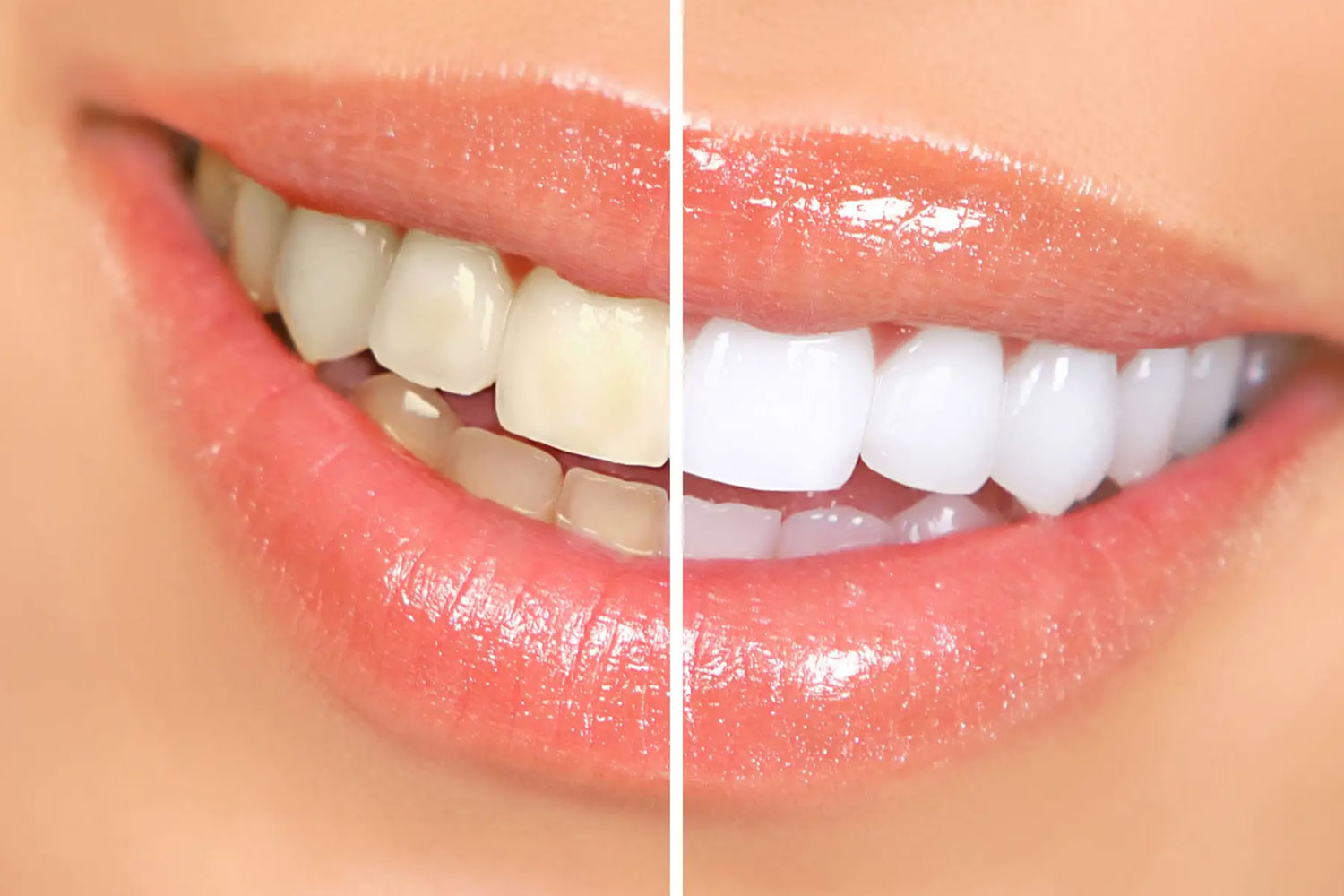 Teeth Whitening